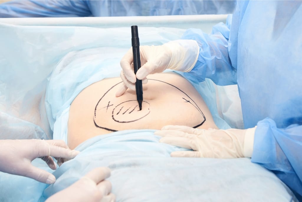 10 Tips To Help You Determine Whether To Fire And Replace A Liposuction Surgeon