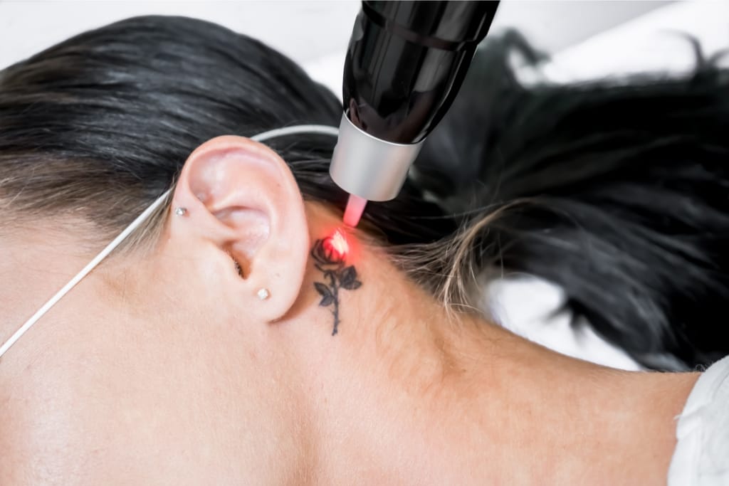 How To Choose A Tattoo Removal Specialist