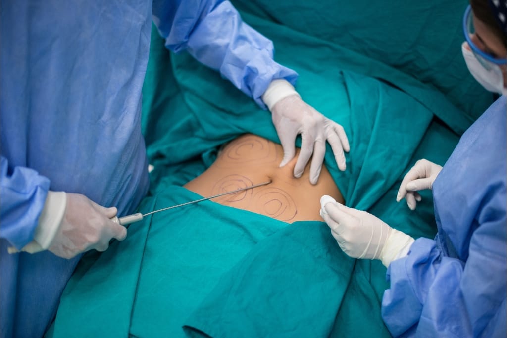 5 Key Factors To Consider When Choosing A Liposuction Clinic