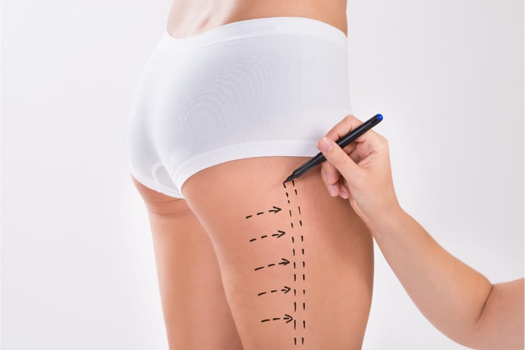 8 Ways To Maintain Your Liposuction Results Long-Term