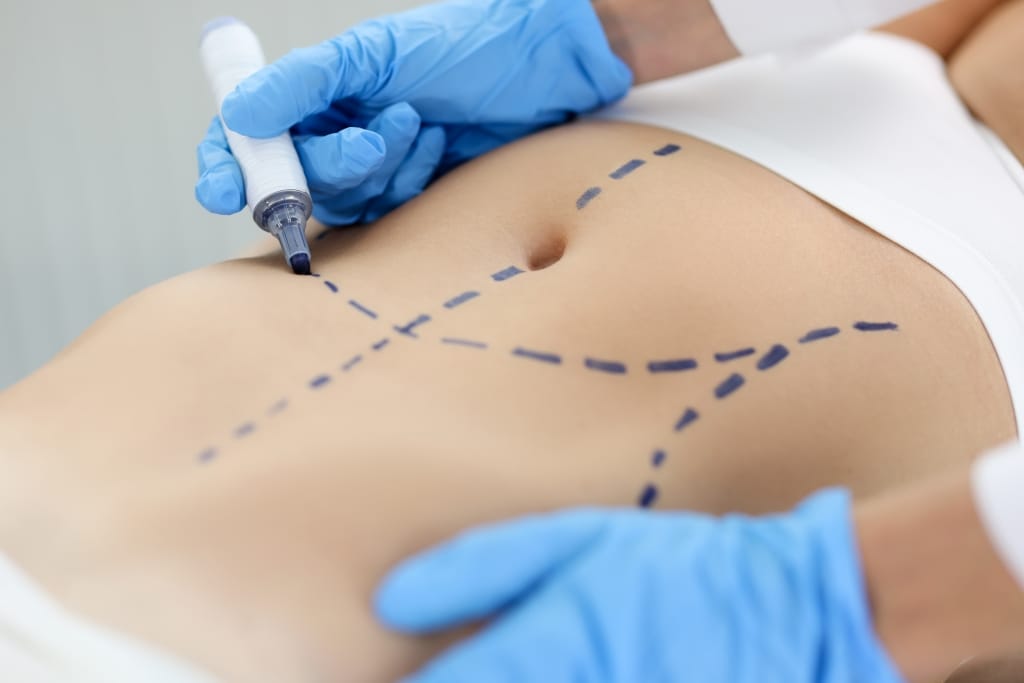 9 Ways To Prepare For Your Liposuction Consultation