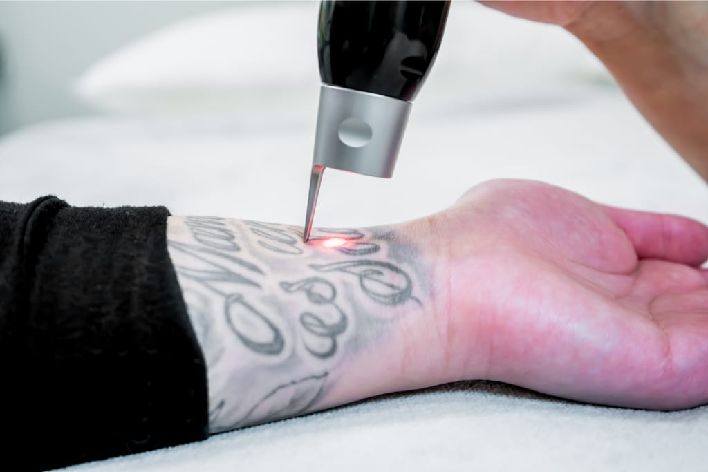 10 Aftercare Tips For A Successful Tattoo Removal Experience