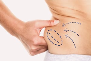 How To Choose A Liposuction Surgeon