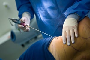 10 Essential Questions To Ask Your Liposuction Surgeon