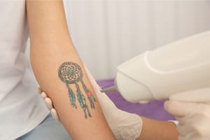 10 Frequently Asked Questions About The Tattoo Removal Process