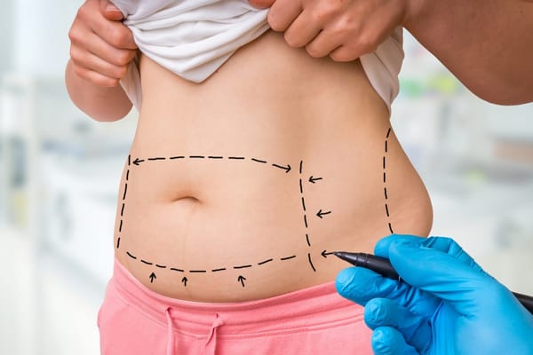 10 Tips For Finding The Best Liposuction Surgeons