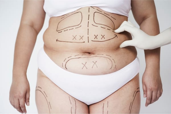 7 Common Misconceptions About Liposuction Debunked