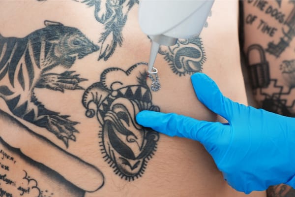 5 Common Myths About Tattoo Removal Debunked