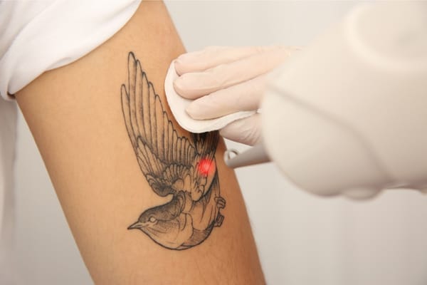 7 Factors That Influence Tattoo Removal Cost